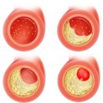 ARTERIOESCLEROSIS ARTERIOPATIAS